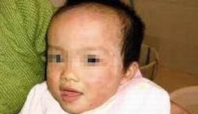 造成全身皮肤过敏原因是什么