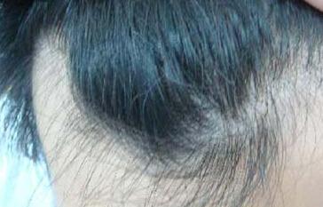怎么减轻脱发的症状