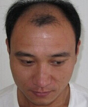 如何做好脱发的预防