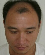 脱发的原因都有哪些