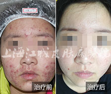 青春痘出现在鼻子上该怎么办