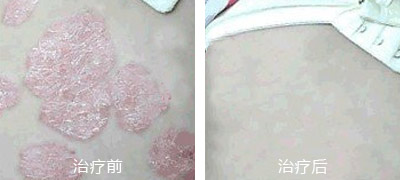 红皮病患者平时要怎样护理