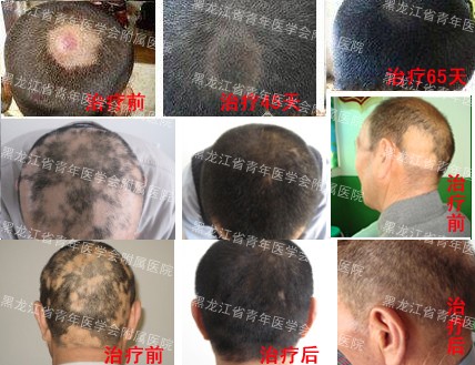 哈尔滨皮肤病医院