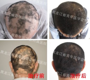 哈尔滨皮肤病医院